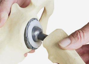 hip implant lawsuit