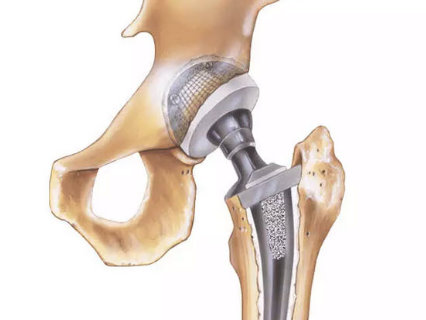 hip implant complications